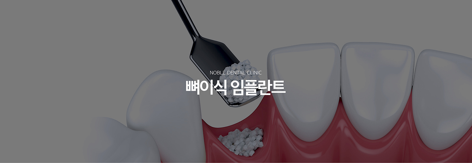 수원 뼈이식 임플란트 대표 안내 - 뼈이식 임플란트는 임플란트를 안정적으로 지지할 잇몸뼈가 부족할 때 결손 부위의 형태를 보완하고 식립 환경을 만드는 치료입니다. 단순히 뼈의 양만 보는 것이 아니라 결손의 위치와 형태, 잇몸 상태, 주변 해부학적 구조를 함께 확인합니다.
