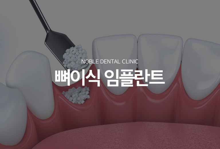 수원 뼈이식 임플란트 대표 안내 - 뼈이식 임플란트는 임플란트를 안정적으로 지지할 잇몸뼈가 부족할 때 결손 부위의 형태를 보완하고 식립 환경을 만드는 치료입니다. 단순히 뼈의 양만 보는 것이 아니라 결손의 위치와 형태, 잇몸 상태, 주변 해부학적 구조를 함께 확인합니다.