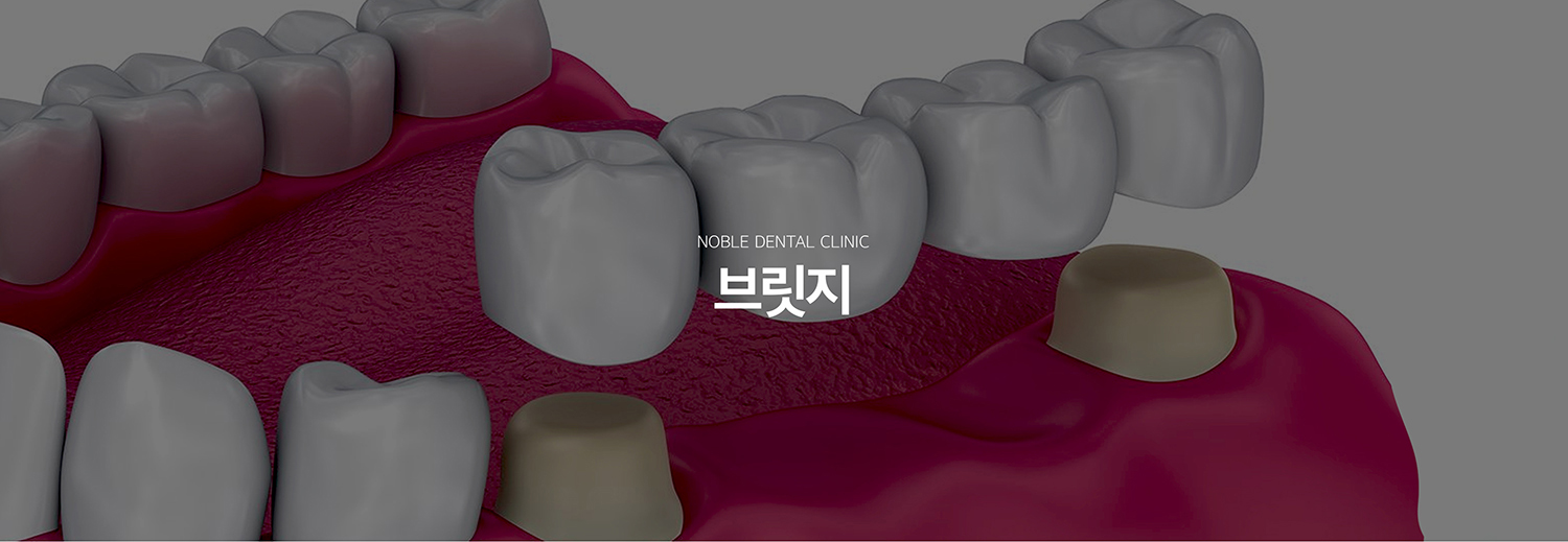 수원 브릿지 치료 대표 안내 - 브릿지는 빠진 치아 양옆의 치아를 지지대로 이용해 결손 부위를 연결하는 고정성 보철입니다. 수술 없이 치아 상실 부위를 회복할 수 있지만 지지 치아를 삭제해야 하므로 양옆 치아의 상태와 장기적인 부담을 함께 평가합니다.