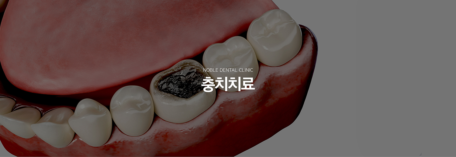 수원 충치치료 대표 안내 - 충치치료는 검게 보이는 부분의 크기만으로 결정하지 않고 충치가 법랑질, 상아질, 치수 가까이 어디까지 진행했는지와 남아 있는 치아 구조를 확인해 치료 범위를 정합니다. 가능한 범위에서 건강한 치질을 보존하면서 필요한 수복 방법을 선택합니다.