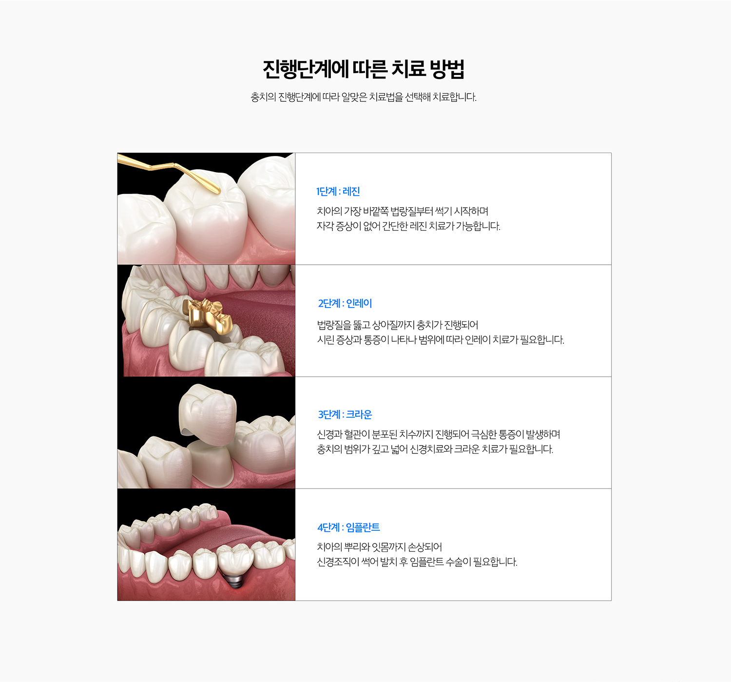 수원 충치치료 상세 안내 - 신경치료가 필요한 경우 - 충치가 치수까지 진행해 회복이 어렵거나 심한 자발통과 감염이 있는 경우에는 신경치료가 필요할 수 있습니다. 단순히 깊어 보인다는 이유만으로 신경치료를 결정하지 않고 증상과 검사 결과를 함께 봅니다. / 치료한 치아에도 다시 충치가 생길 수 있습니다 - 충전물과 크라운 경계 주변에 치태가 쌓이거나 접착 경계가 변하면 2차 충치가 생길 수 있어 정기검진이 필요합니다.
