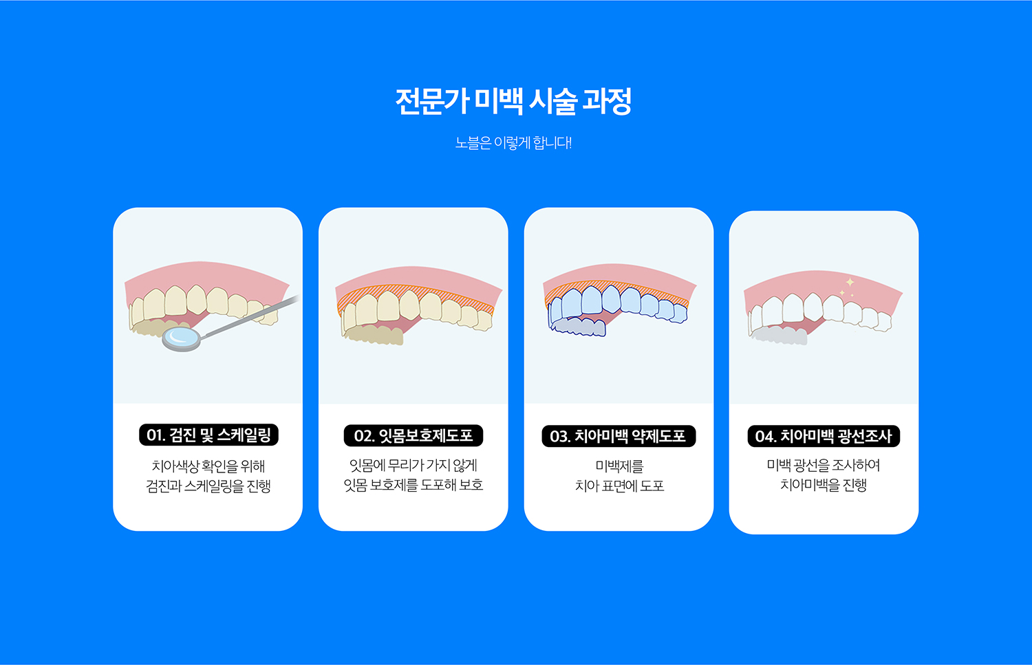 수원 치아미백 상세 안내 - 전문가 미백 - 치과에서 잇몸을 보호한 뒤 고농도 미백제를 사용해 진행할 수 있습니다. 필요한 횟수와 목표 색은 현재 치아 색과 민감도에 따라 조절합니다.