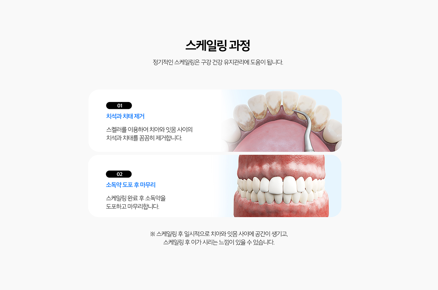 수원 스케일링 상세 안내 - 치료 후 시린 느낌 - 치석이 덮고 있던 치아 뿌리 표면이 노출되거나 잇몸 부종이 줄면서 일시적으로 시릴 수 있습니다. 증상이 지속되면 다른 원인이 있는지 확인합니다.