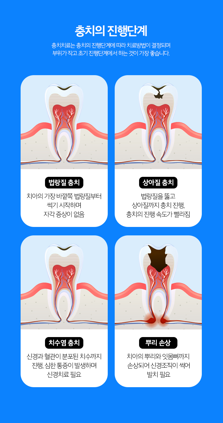 수원 충치치료 상세 안내 - 레진·인레이·크라운 선택 - 작은 범위는 직접 수복을 고려하고, 손상 범위가 넓거나 씹는 힘을 크게 받는 부위는 인레이·온레이 또는 크라운 같은 간접 보철을 검토합니다.