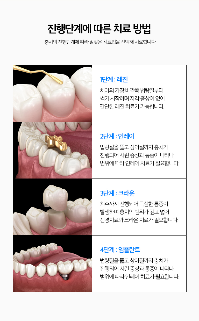 수원 충치치료 상세 안내 - 신경치료가 필요한 경우 - 충치가 치수까지 진행해 회복이 어렵거나 심한 자발통과 감염이 있는 경우에는 신경치료가 필요할 수 있습니다. 단순히 깊어 보인다는 이유만으로 신경치료를 결정하지 않고 증상과 검사 결과를 함께 봅니다. / 치료한 치아에도 다시 충치가 생길 수 있습니다 - 충전물과 크라운 경계 주변에 치태가 쌓이거나 접착 경계가 변하면 2차 충치가 생길 수 있어 정기검진이 필요합니다.