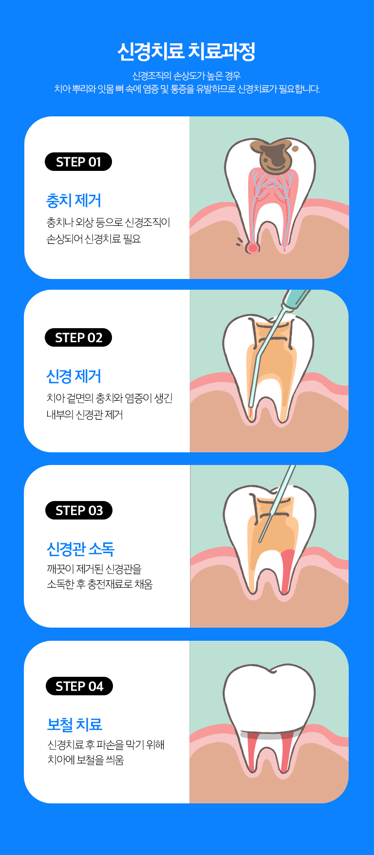 수원 신경치료 상세 안내 - 근관치료 과정 - 치아 내부로 접근해 감염된 치수 조직을 제거하고 근관 길이와 형태를 확인한 뒤 세척과 소독을 반복합니다. 내부 상태가 안정되면 근관을 충전하고 치아 상부를 수복합니다.