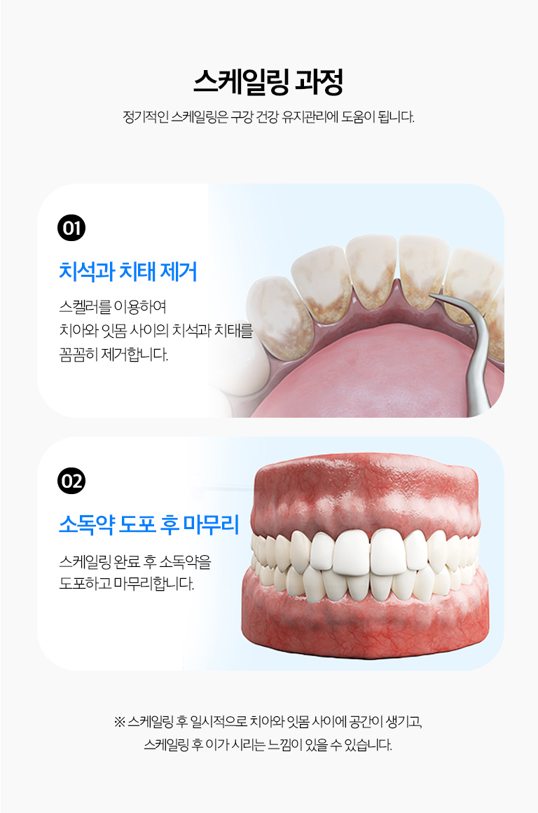 수원 스케일링 상세 안내 - 치료 후 시린 느낌 - 치석이 덮고 있던 치아 뿌리 표면이 노출되거나 잇몸 부종이 줄면서 일시적으로 시릴 수 있습니다. 증상이 지속되면 다른 원인이 있는지 확인합니다.